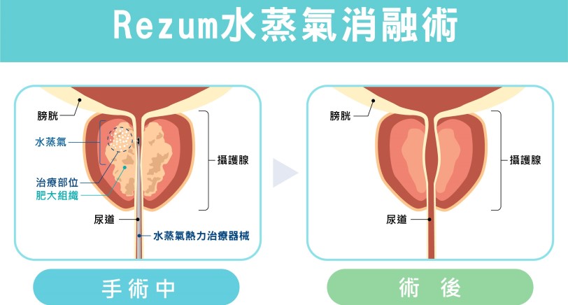 攝護腺肥大微創治療的新時代  Rezum水蒸氣消融與雷射攝護腺手術