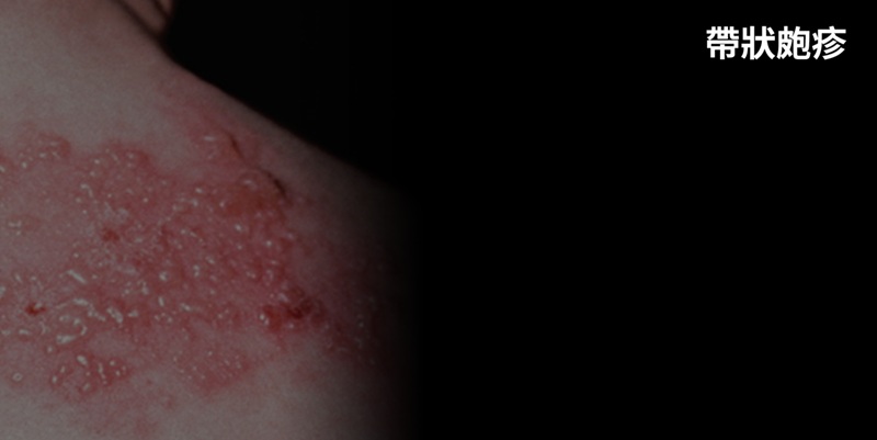 李雅芬建議輔助弱勢族群施打帶狀疱症疫苗 陳其邁同意研訂可行辦法