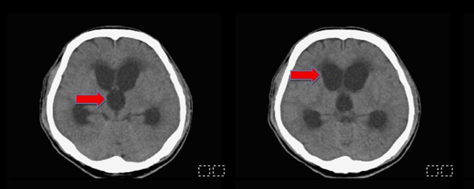 高市油漆工腦傷顱內出血併發水腦症 民生醫院腦室腹腔分流術治療恢復意識