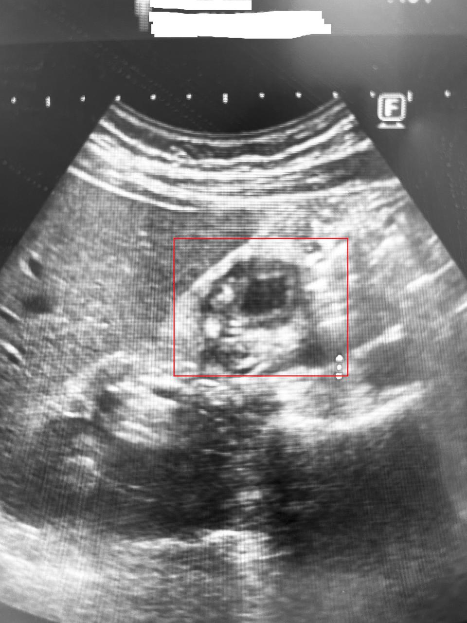 高市男心臟腹痛確診膽囊腺肌症 博田國際醫院單孔腹腔鏡切除膽囊重拾正常生活