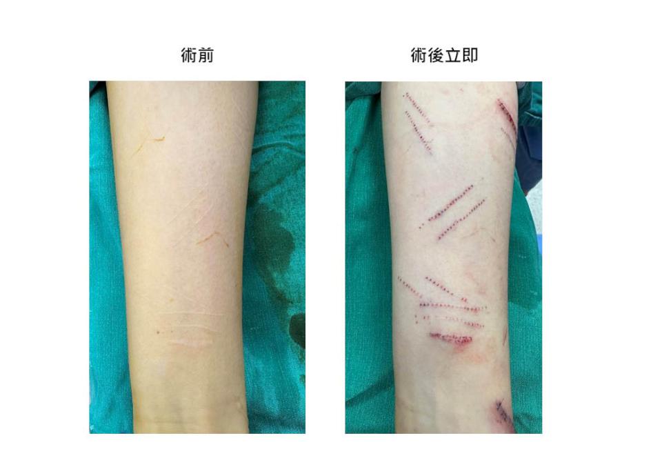 英國籍香港女自殘盼父母關愛未果 跨海求治台灣資深整形外科名醫曹賜斌除疤治心