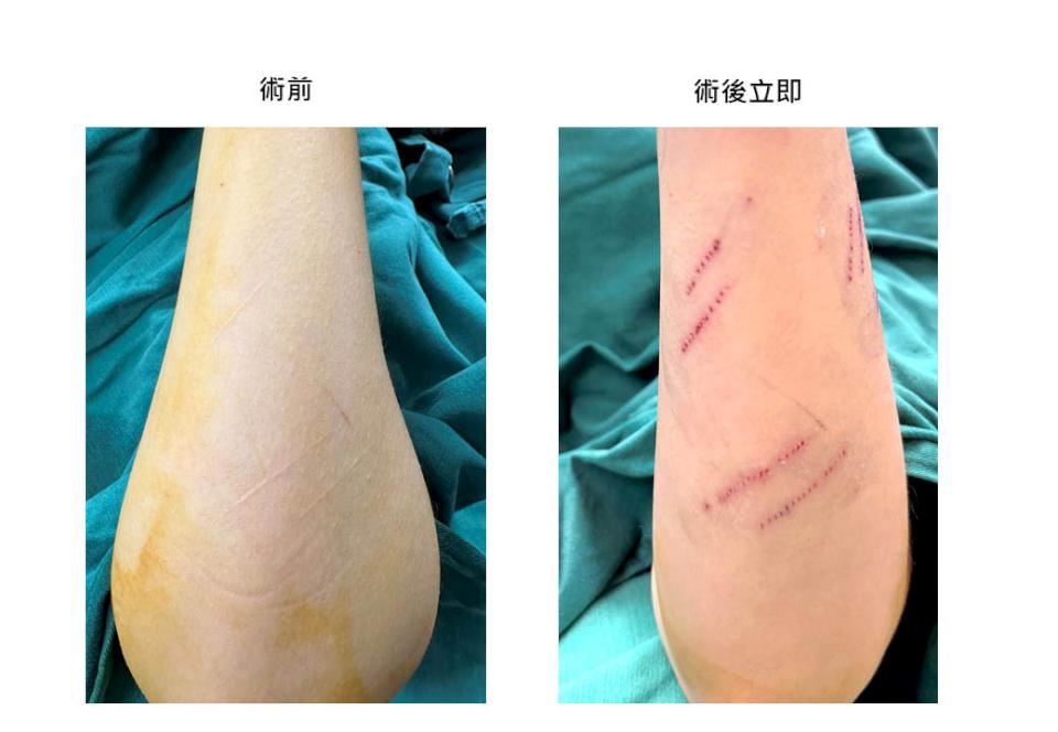 英國籍香港女自殘盼父母關愛未果 跨海求治台灣資深整形外科名醫曹賜斌除疤治心